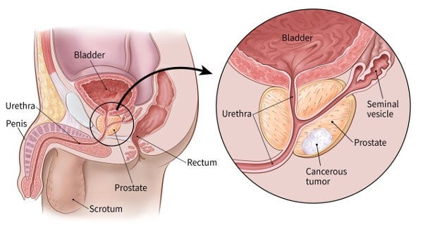 Prostate Cancer