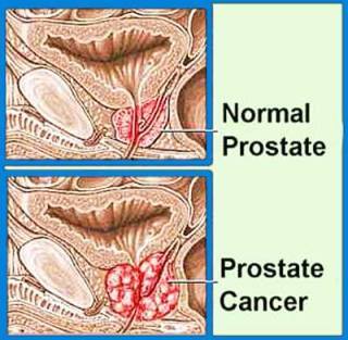 Prostate Cancer