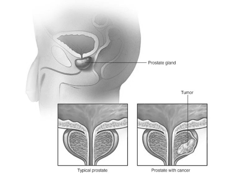 Prostate cancer