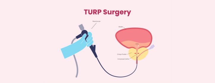 TUR-P surgery