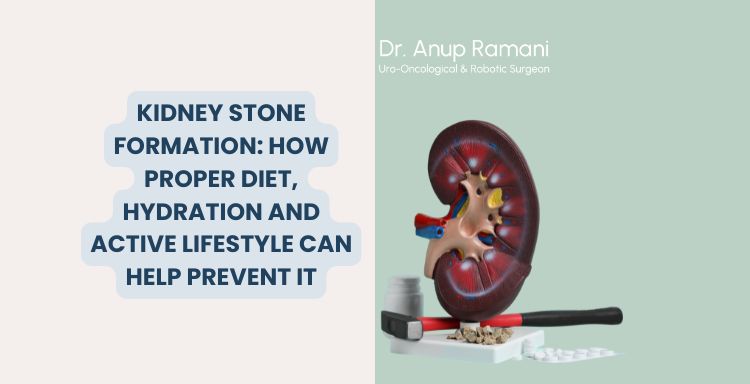 Kidney Stone Formation: How Proper Diet, Hydration and Active Lifestyle Can Help Prevent It