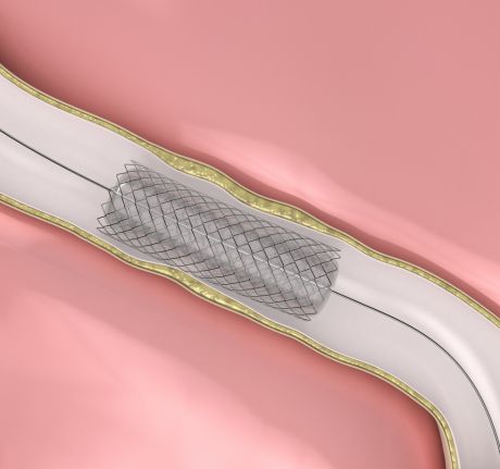 Stent