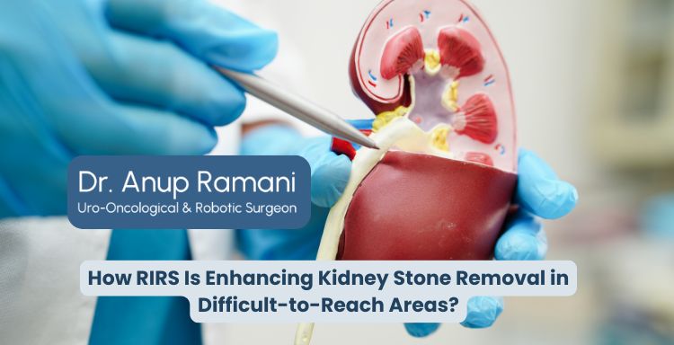How RIRS Is Enhancing Kidney Stone Removal in Difficult-to-Reach Areas?