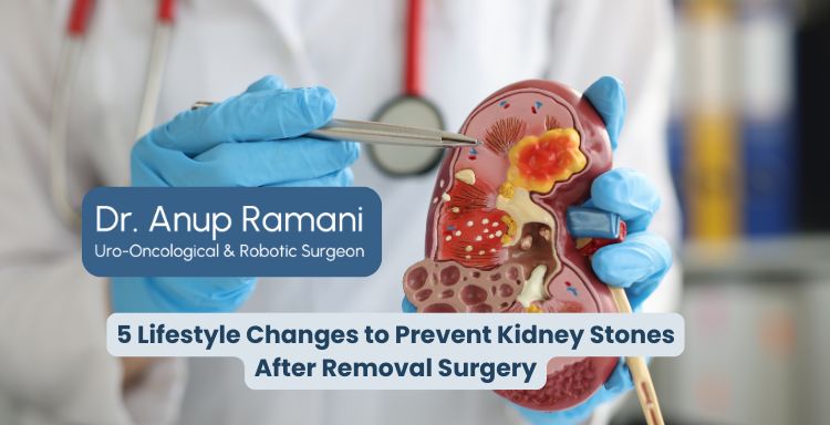 5 Lifestyle Changes to Prevent Kidney Stones After Removal Surgery