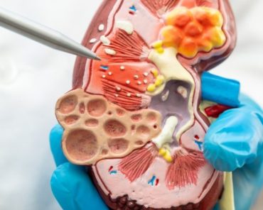 What Care is Needed After URS / RIRS Kidney Stone R ...