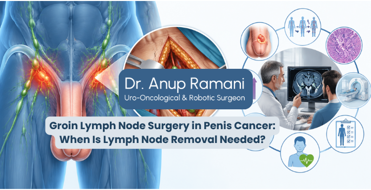 Groin Lymph Node Surgery in Penis Cancer: When Is Lymph Node Removal Needed?